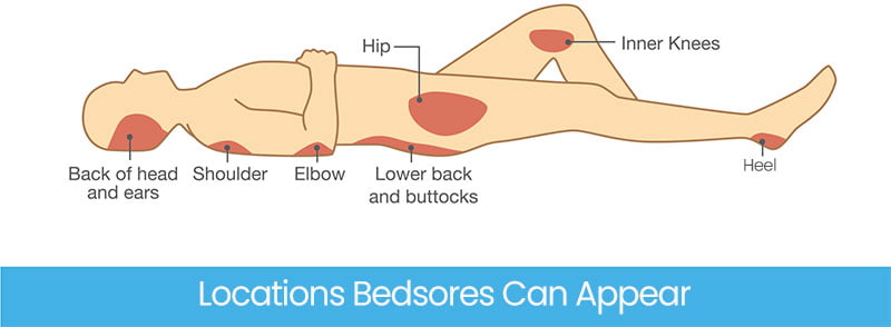 Locations on the body to look for bedsores 2