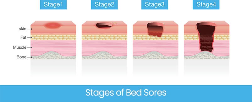Stages of Bed Sores