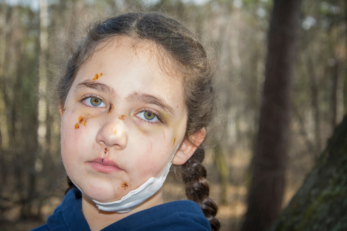A young girl with a bandage on her face, showing signs of recovery after a dog attack at an Ohio park.