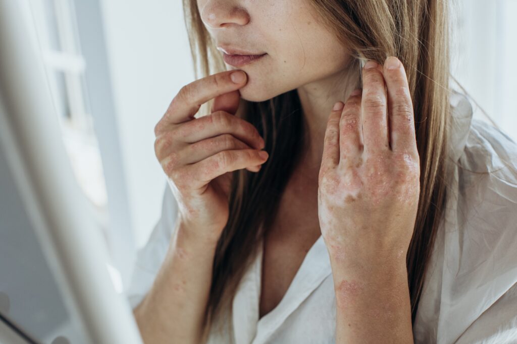 Sick,Person.,Unrecognizable,Young,Woman,Suffering,From,Autoimmune,Incurable,Dermatological