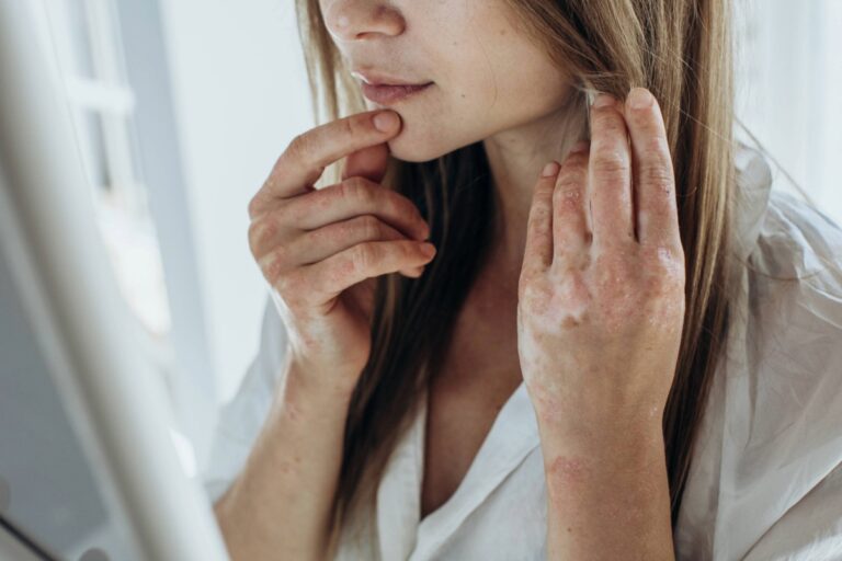 A woman in a white shirt touches her face and hair, showing signs of skin condition on her hands.