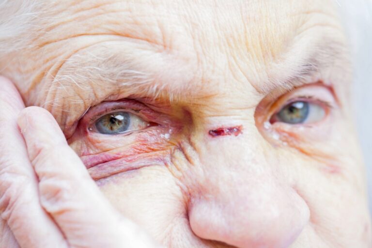 Close-up of elderly woman's face showing facial injury and bruising on nose and forehead – potential sign of nursing home neglect in Ohio assisted living facilities
